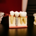 Dental implant model showing how implants replace missing teeth, Avon, IN