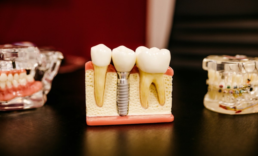 Dental implant model showing how implants replace missing teeth, Avon, IN