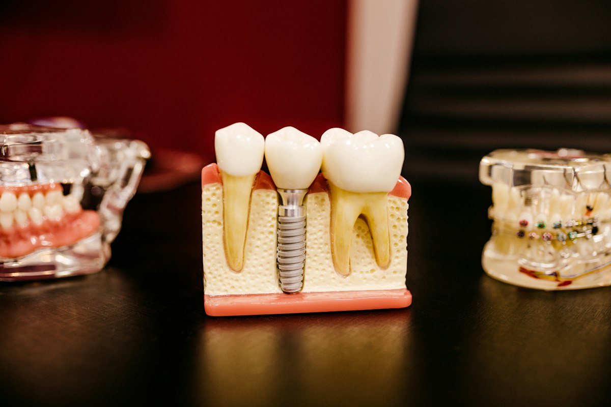 Dental implant model showing how implants replace missing teeth, Avon, IN